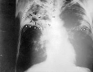 tuberculosis x-ray nursing-resource