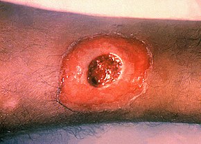 diphtheria skin lesion nursing-resource