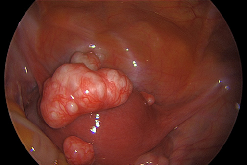 uterine febroids nursing-resource