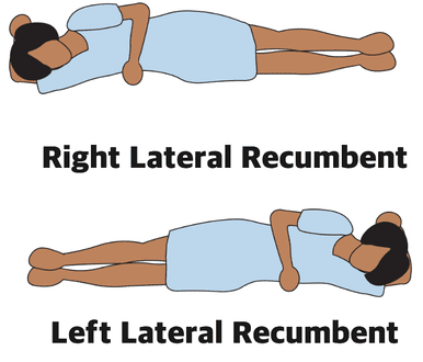 Lateral Recumbent Position