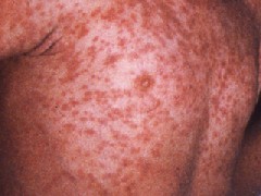 measles nursing-resource.com