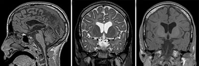 microcephaly imaging nursing-resource.com